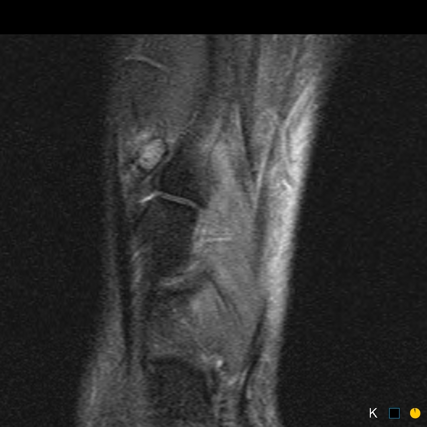 Figure 4 for case Symptomatic os intermetatarseum